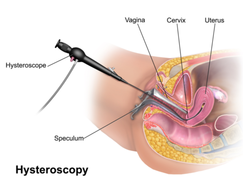 Uterine Ailments: Evaluation and Treatment with Hysteroscopy